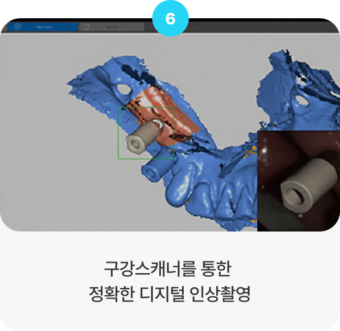 구강스캐너를 통한 정확한 디지털 인상촬영