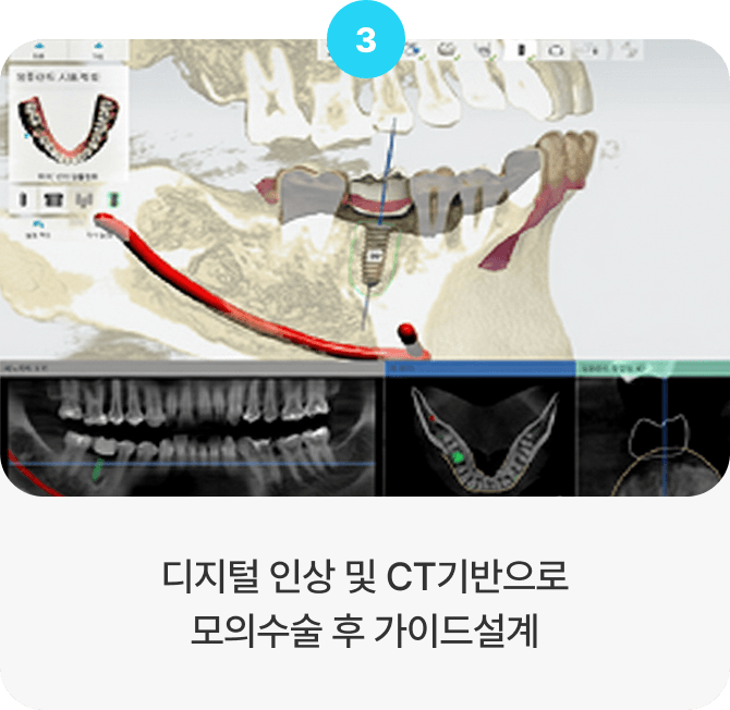 디지털 인상 및 CT기반으로 모의수술 후 가이드설계