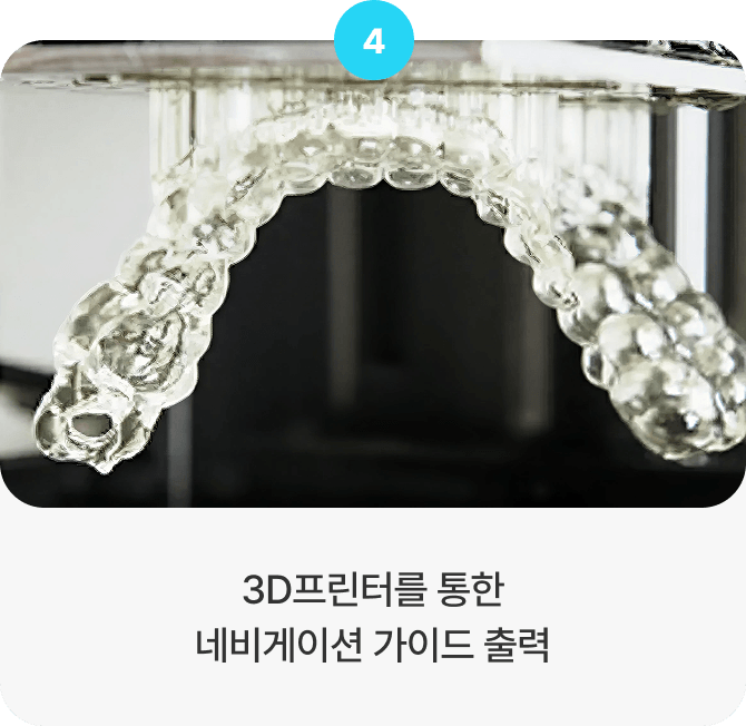 3D프린터를 통한 네비게이션 가이드 출력