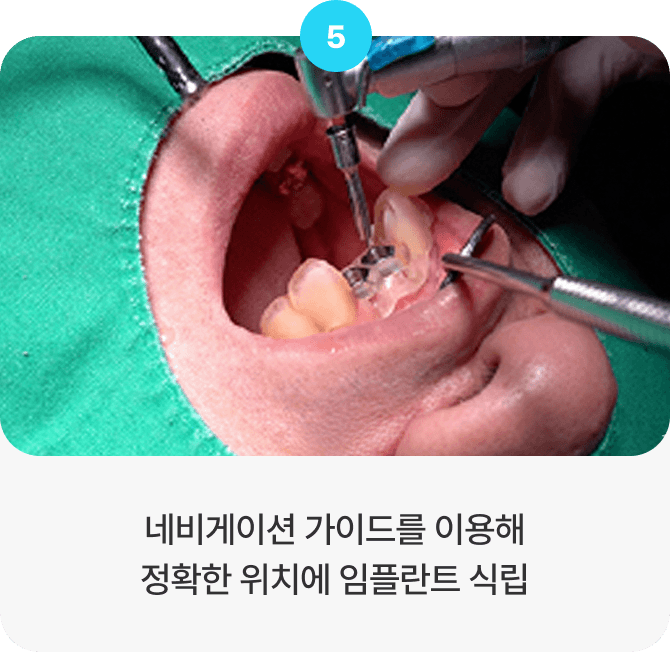 네비게이션 가이드를 이용해 정확한 위치에 임플란트 식립