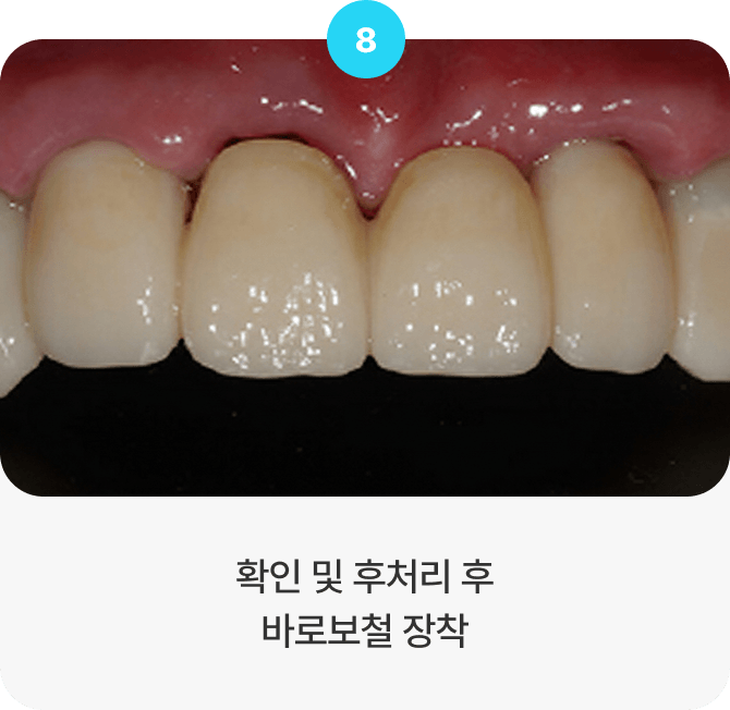 확인 및 후처리 후 바로보철 장착