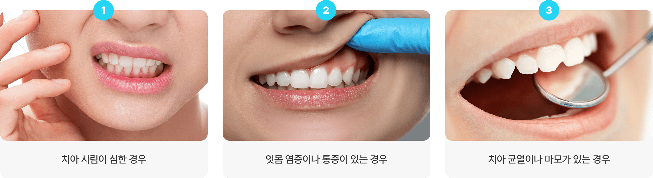 1.치아 시림이 심한 경우, 2.잇몸 염증이나 통증이 있는 경우, 3.치아 균열이나 마모가 있는 경우