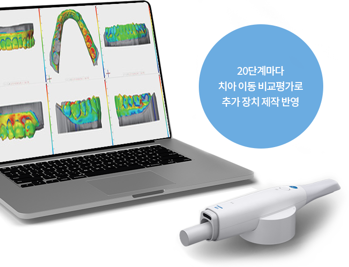 20단계마다 치아 이동 비교평가로 추가 장치 제작 반영